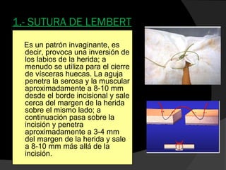  También llamado punto de colchonero vertical
 Es una sutura útil en zonas de piel laxa (dorso de la mano,
codo), donde ...