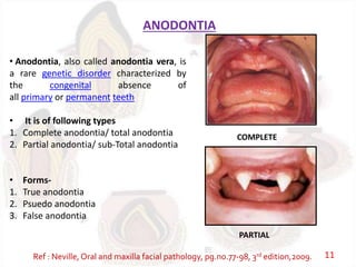 ANODONTIA
• Anodontia, also called anodontia vera, is
a rare genetic disorder characterized by
the congenital absence of
all primary or permanent teeth
• It is of following types
1. Complete anodontia/ total anodontia
2. Partial anodontia/ sub-Total anodontia
• Forms-
1. True anodontia
2. Psuedo anodontia
3. False anodontia
COMPLETE
PARTIAL
Ref : Neville, Oral and maxilla facial pathology, pg.no.77-98, 3rd edition,2009. 11
 