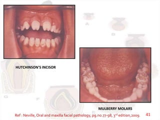 HUTCHINSON’S INCISOR
MULBERRY MOLARS
Ref : Neville, Oral and maxilla facial pathology, pg.no.77-98, 3rd edition,2009. 41
 