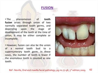 FUSION
• The phenomenon of tooth
fusion arises through union of two
normally separated tooth germs, and
depending upon the stage of
development of the teeth at the time of
union, it may be either complete or
incomplete.
• However, fusion can also be the union
of a normal tooth bud to a
supernumerary tooth germ. In these
cases, the number of teeth is fewer if
the anomalous tooth is counted as one
tooth.
Ref : Neville, Oral and maxilla facial pathology, pg.no.77-98, 3rd edition,2009. 42
 