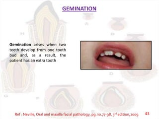 GEMINATION
Gemination arises when two
teeth develop from one tooth
bud and, as a result, the
patient has an extra tooth
Ref : Neville, Oral and maxilla facial pathology, pg.no.77-98, 3rd edition,2009. 43
 