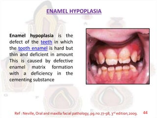 ENAMEL HYPOPLASIA
Enamel hypoplasia is the
defect of the teeth in which
the tooth enamel is hard but
thin and deficient in amount
This is caused by defective
enamel matrix formation
with a deficiency in the
cementing substance
Ref : Neville, Oral and maxilla facial pathology, pg.no.77-98, 3rd edition,2009. 44
 