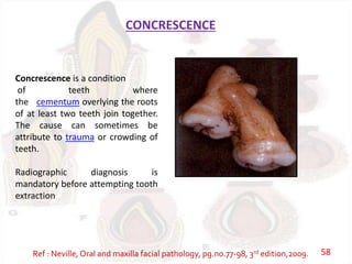 CONCRESCENCE
Concrescence is a condition
of teeth where
the cementum overlying the roots
of at least two teeth join together.
The cause can sometimes be
attribute to trauma or crowding of
teeth.
Radiographic diagnosis is
mandatory before attempting tooth
extraction
Ref : Neville, Oral and maxilla facial pathology, pg.no.77-98, 3rd edition,2009. 58
 