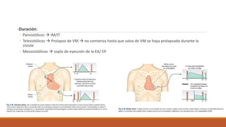 -Duración:
◦ Pansistólicos  IM/IT
◦ Telesistólicos  Prolapso de VM  no comienza hasta que valva de VM se haya prolapsado durante la
sístole
◦ Mesosistólicos  soplo de eyección de la EA/ EP
 