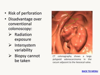 INVESTIGATIONS OF RIGHT COLONIC CANCER | PPTX