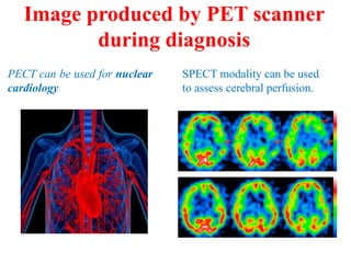 Image produced by PET scanner
during diagnosis
PECT can be used for nuclear
cardiology
SPECT modality can be used
to assess cerebral perfusion.
 