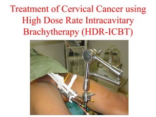 Treatment of Cervical Cancer using
High Dose Rate Intracavitary
Brachytherapy (HDR-ICBT)
 