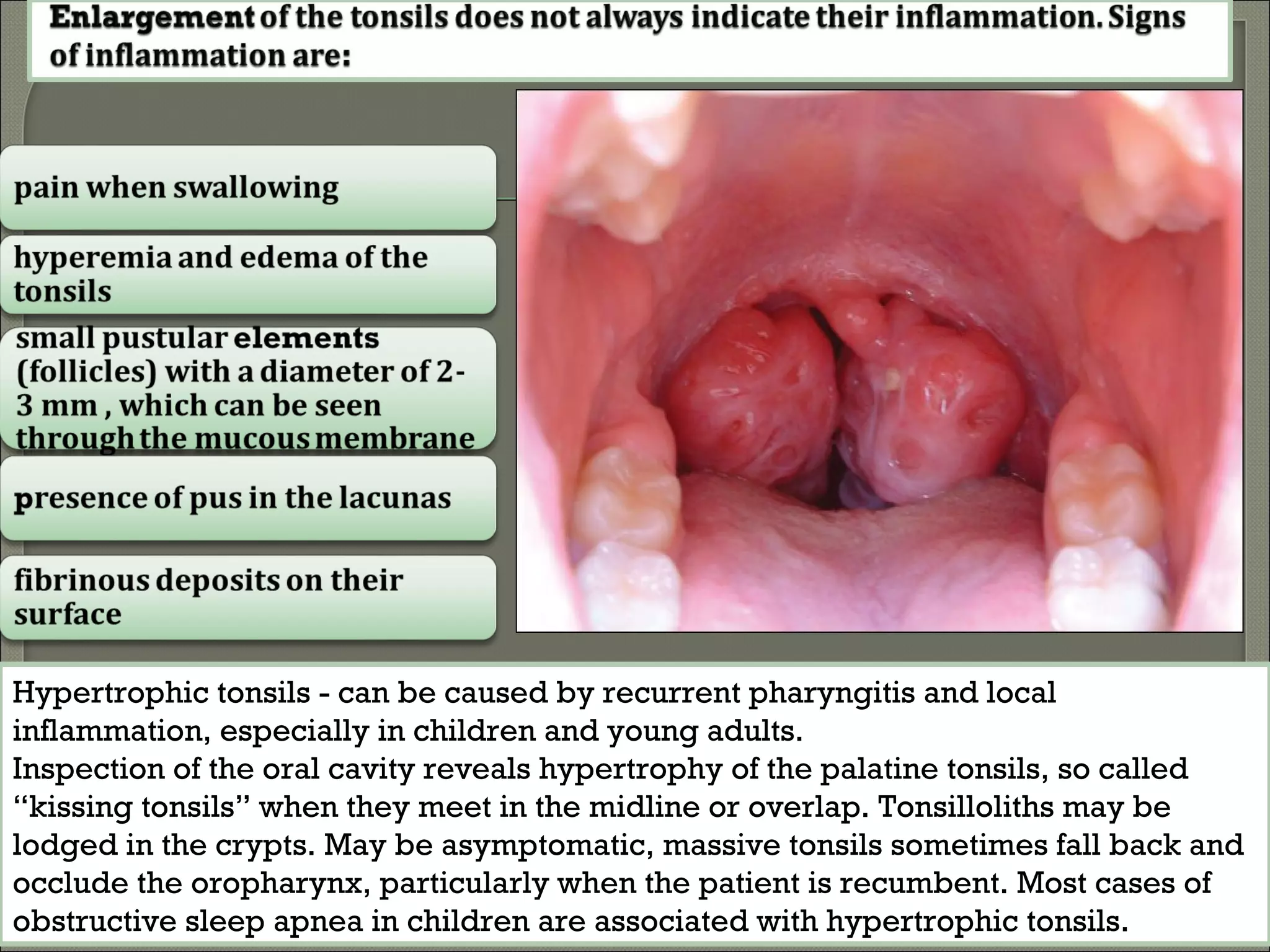 Tonsillitis Syndrome In Children Diphtheria PPT tonsillitis-syndrome-in-children-diphtheria-ppt