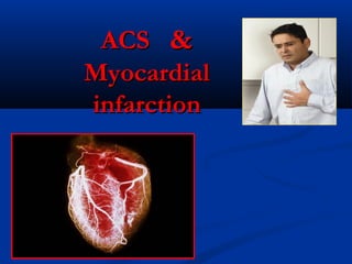 ACSACS &&
MyocardialMyocardial
infarctioninfarction
 