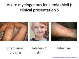 Leukemia | PDF