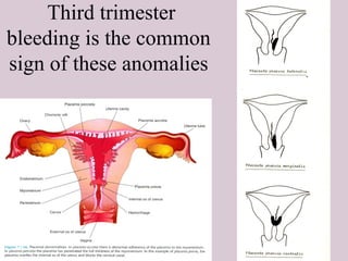 19
Third trimester
bleeding is the common
sign of these anomalies
 