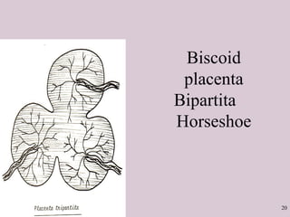 20
Biscoid
placenta
Bipartita
Horseshoe
 