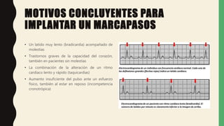 MOTIVOS CONCLUYENTES PARA
IMPLANTAR UN MARCAPASOS
• Un latido muy lento (bradicardia) acompañado de
molestias
• Trastornos graves de la capacidad del corazón,
también en pacientes sin molestias
• La combinación de la alteración de un ritmo
cardiaco lento y rápido (taquicardias)
• Aumento insuficiente del pulso ante un esfuerzo
físico, también al estar en reposo (incompetencia
cronotrópica)
 