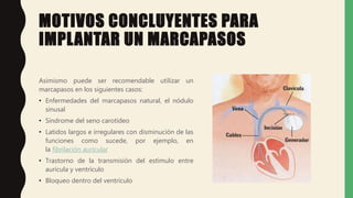 MOTIVOS CONCLUYENTES PARA
IMPLANTAR UN MARCAPASOS
Asimismo puede ser recomendable utilizar un
marcapasos en los siguientes casos:
• Enfermedades del marcapasos natural, el nódulo
sinusal
• Síndrome del seno carotídeo
• Latidos largos e irregulares con disminución de las
funciones como sucede, por ejemplo, en
la fibrilación auricular
• Trastorno de la transmisión del estímulo entre
aurícula y ventrículo
• Bloqueo dentro del ventrículo
 