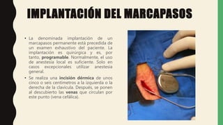 IMPLANTACIÓN DEL MARCAPASOS
• La denominada implantación de un
marcapasos permanente está precedida de
un examen exhaustivo del paciente. La
implantación es quirúrgica y es, por
tanto, programable. Normalmente, el uso
de anestesia local es suficiente. Solo en
casos excepcionales utilizar anestesia
general.
• Se realiza una incisión dérmica de unos
cinco o seis centímetros a la izquierda o la
derecha de la clavícula. Después, se ponen
al descubierto las venas que circulan por
este punto (vena cefálica).
 
