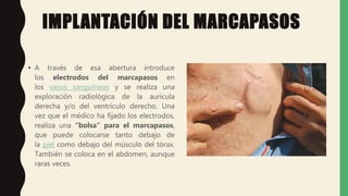 IMPLANTACIÓN DEL MARCAPASOS
• A través de esa abertura introduce
los electrodos del marcapasos en
los vasos sanguíneos y se realiza una
exploración radiológica de la aurícula
derecha y/o del ventrículo derecho. Una
vez que el médico ha fijado los electrodos,
realiza una “bolsa” para el marcapasos,
que puede colocarse tanto debajo de
la piel como debajo del músculo del tórax.
También se coloca en el abdomen, aunque
raras veces.
 
