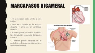 MARCAPASOS BICAMERAL
• El generador está unido a dos
cables.
• Uno está situado en la aurícula
derecha y otro en el ventrículo
derecho.
• El marcapasos bicameral posibilita
la estimulación secuencial de las dos
cámaras
• También puede inhibirse en lo
períodos en los que ambas cámaras
laten normalmente.
 