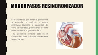 MARCAPASOS RESINCRONIZADOR
• Se caracteriza por tener la posibilidad
de estimular la aurícula y ambos
ventrículos (derecho e izquierdo) de
forma sincronizada, permitiendo de esta
manera mejorar el gasto cardiaco
• La diferencia principal está en el
número de cables utilizados que en este
caso es de tres.
 
