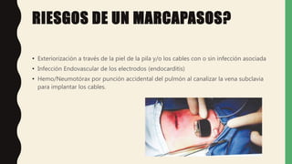 RIESGOS DE UN MARCAPASOS?
• Exteriorización a través de la piel de la pila y/o los cables con o sin infección asociada
• Infección Endovascular de los electrodos (endocarditis)
• Hemo/Neumotórax por punción accidental del pulmón al canalizar la vena subclavia
para implantar los cables.
 