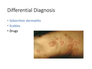 Differential Diagnosis
• Seborrheic dermatitis
• Scabies
• Drugs
 
