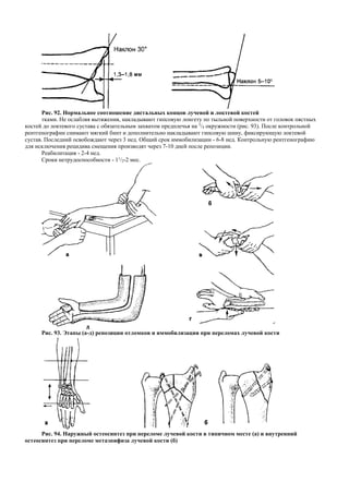 Рис. 92. Нормальное соотношение дистальных концов лучевой и локтевой костей
тками. Не ослабляя вытяжения, накладывают гипсовую лонгету по тыльной поверхности от головок пястных
костей до локтевого сустава с обязательным захватом предплечья на 3
/4 окружности (рис. 93). После контрольной
рентгенографии снимают мягкий бинт и дополнительно накладывают гипсовую шину, фиксирующую локтевой
сустав. Последний освобождают через 3 нед. Общий срок иммобилизации - 6-8 нед. Контрольную рентгенографию
для исключения рецидива смещения производят через 7-10 дней после репозиции.
Реабилитация - 2-4 нед.
Сроки нетрудоспособности - 11
/2-2 мес.
Рис. 93. Этапы (а-д) репозиции отломков и иммобилизация при переломах лучевой кости
Рис. 94. Наружный остеосинтез при переломе лучевой кости в типичном месте (а) и внутренний
остеосинтез при переломе метаэпифиза лучевой кости (б)
 