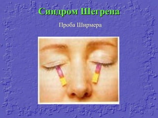 Синдром ШегренаСиндром Шегрена
Проба Ширмера
 
