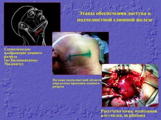 Этапы обеспечения доступа к
подчелюстной слюнной железе
Схематическое
изображение кожного
разреза
(по Палишевскому-
Малевичу)
На коже подчелюстной области
определена проекция кожного
разреза
Рассечена кожа, подкожная
клетчатка, m platisma
 