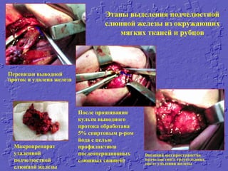 Этапы выделения подчелюстной
слюнной железы из окружающих
мягких тканей и рубцов
Перевязан выводной
проток и удалена железа
Внешний вид пространства
подчелюстного треугольника
после удаления железы
После прошивания
культя выводного
протока обработана
5% спиртовым р-ром
йода с целью
профилактики
послеоперационных
слюнных свищей)
Макропрепарат
удаленной
подчелюстной
слюнной железы
 