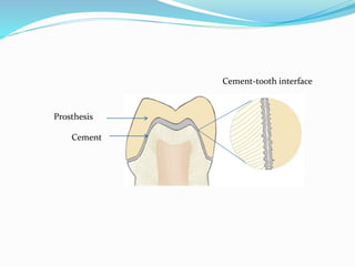 Prosthesis
Cement
Cement-tooth interface
 