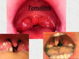 Tonsillitis
 