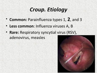 Croup. Etiology
• Common: Parainfluenza types 1, 2, and 3
• Less common: Influenza viruses A, B
• Rare: Respiratory syncytial virus (RSV),
adenovirus, measles
 