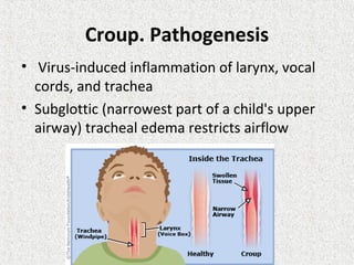 Croup. Pathogenesis
• Virus-induced inflammation of larynx, vocal
cords, and trachea
• Subglottic (narrowest part of a child's upper
airway) tracheal edema restricts airflow
 