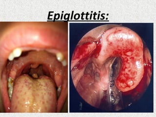Epiglottitis:
 