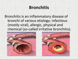 Bronchitis
Bronchitis is an inflammatory disease of
bronchi of various etiology: infectious
(mostly viral), allergic, physical and
chemical (so-called irritative bronchitis).
 