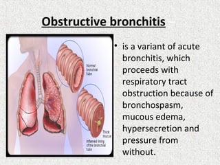 Obstructive bronchitis –
• is a variant of acute
bronchitis, which
proceeds with
respiratory tract
obstruction because of
bronchospasm,
mucous edema,
hypersecretion and
pressure from
without.
 
