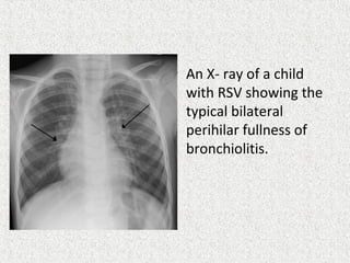 • An X- ray of a child
with RSV showing the
typical bilateral
perihilar fullness of
bronchiolitis.
 