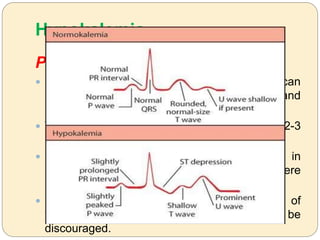 Hypokalemia
Prevention and Treatment:
 Excess potassium removal during HD can
prolong QTc interval on EKG preferentially and
predispose to arrhythmia2
 Try to keep post dialysis serum potassium 2-3
mEq/L
 Use dialysate with 3.0 mEq/l of potassium in
patients with CAD and/or on digoxin, unless there
is chronic, severe hyperkalemia
 Never use 0 mE/L potassium dialysate. Use of
very low dialysate potassium (1 mEq/L) should be
discouraged.
 