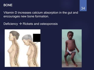 BONE
Vitamin D increases calcium absorption in the gut and
encourages new bone formation.
Deficiency  Rickets and osteoporosis
34
 
