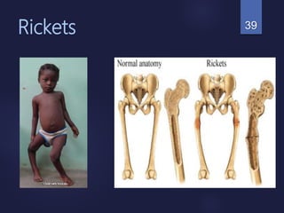 Rickets 39
 