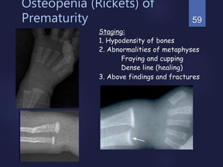 59
Osteopenia (Rickets) of
Prematurity
Staging:
1. Hypodensity of bones
2. Abnormalities of metaphyses
Fraying and cupping
Dense line (healing)
3. Above findings and fractures
 