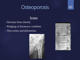 Osteoporosis
X-rays
- Decrease bone density
- Wedging or biconcave vertebrae
- Thin cortex and deformities
65
 
