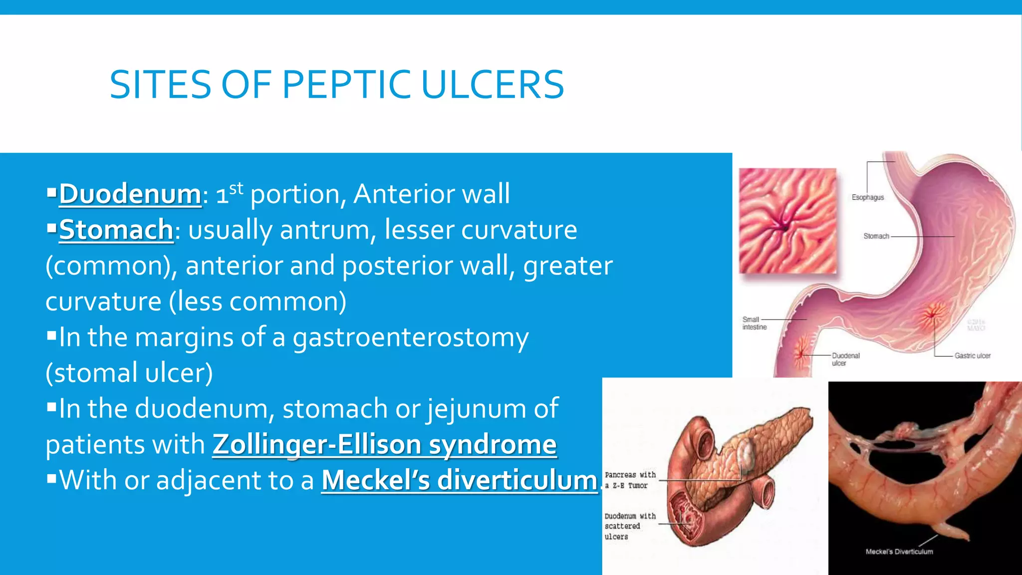 SITES OF PEPTIC ULCERS
Duodenum: 1st portion, Anterior wall
Stomach: usually antrum, lesser curvature
(common), anterior and posterior wall, greater
curvature (less common)
In the margins of a gastroenterostomy
(stomal ulcer)
In the duodenum, stomach or jejunum of
patients with Zollinger-Ellison syndrome
With or adjacent to a Meckel’s diverticulum.
 