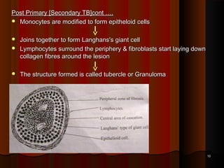 Post Primary [Secondary TB]cont ….Post Primary [Secondary TB]cont ….
 Monocytes are modified to form epitheloid cellsMonocytes are modified to form epitheloid cells
  
 Joins together to form Langhans's giant cellJoins together to form Langhans's giant cell
 Lymphocytes surround the periphery & fibroblasts start laying downLymphocytes surround the periphery & fibroblasts start laying down
collagen fibres around the lesioncollagen fibres around the lesion
  
 The structure formed is called tubercle or GranulomaThe structure formed is called tubercle or Granuloma
1010
 