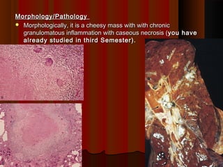 Morphology/PathologyMorphology/Pathology
 Morphologically, it is a cheesy mass with with chronicMorphologically, it is a cheesy mass with with chronic
granulomatous inflammation with caseous necrosis (granulomatous inflammation with caseous necrosis (you haveyou have
already studied in third Semester).already studied in third Semester).
1515
 