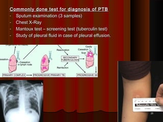 Commonly done test for diagnosis of PTBCommonly done test for diagnosis of PTB
- Sputum examination (3 samples)Sputum examination (3 samples)
- Chest X-RayChest X-Ray
- Mantoux test – screening test (tuberculin test)Mantoux test – screening test (tuberculin test)
- Study of pleural fluid in case of pleural effusion.Study of pleural fluid in case of pleural effusion.
2525
 