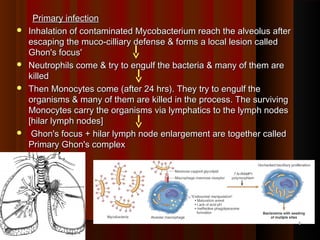 Primary infectionPrimary infection
 Inhalation of contaminated Mycobacterium reach the alveolus afterInhalation of contaminated Mycobacterium reach the alveolus after
escaping the muco-cilliary defense & forms a local lesion calledescaping the muco-cilliary defense & forms a local lesion called
Ghon's focus'Ghon's focus'
 Neutrophils come & try to engulf the bacteria & many of them areNeutrophils come & try to engulf the bacteria & many of them are
killed killed 
 Then Monocytes come (after 24 hrs). They try to engulf theThen Monocytes come (after 24 hrs). They try to engulf the
organisms & many of them are killed in the process. The survivingorganisms & many of them are killed in the process. The surviving
Monocytes carry the organisms via lymphatics to the lymph nodesMonocytes carry the organisms via lymphatics to the lymph nodes
[hilar lymph nodes][hilar lymph nodes]
 Ghon's focus + hilar lymph node enlargement are together calledGhon's focus + hilar lymph node enlargement are together called
Primary Ghon's complexPrimary Ghon's complex
  
66
 