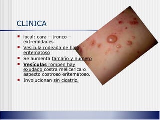 CLINICA
 local: cara – tronco –
extremidades
 Vesícula rodeada de halo
eritematoso
 Se aumenta tamaño y numero
 Vesículas rompen hay
exudado costra melicerica o
aspecto costroso eritematoso.
 Involucionan sin cicatriz.
 