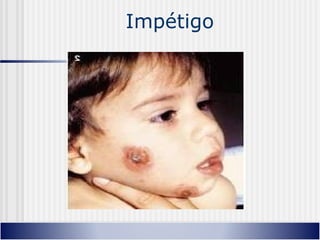 Impétigo
 