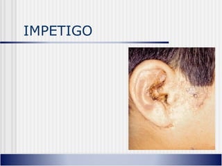 IMPETIGO
 