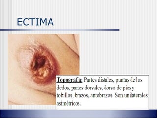 ECTIMA
 